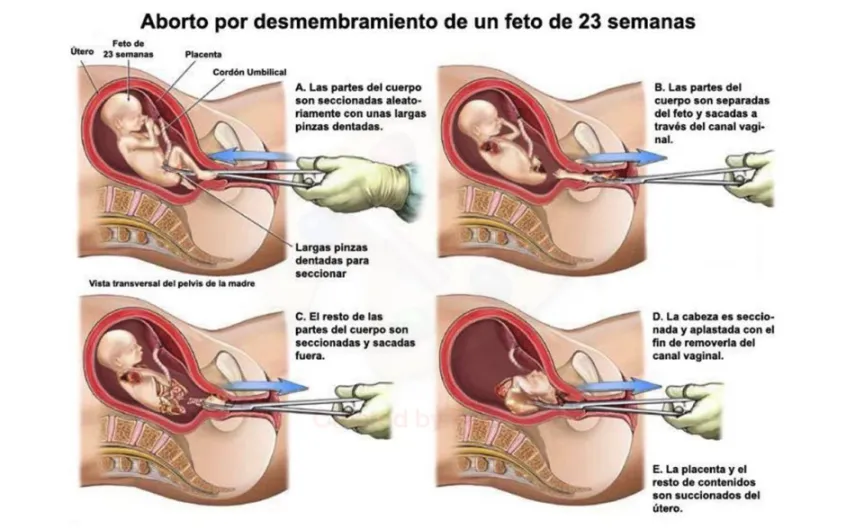 EEUU. Texas prohíbe el aborto por desmembramiento, el que “desgarra el cuerpo de un niño mientras su corazón todavía late”