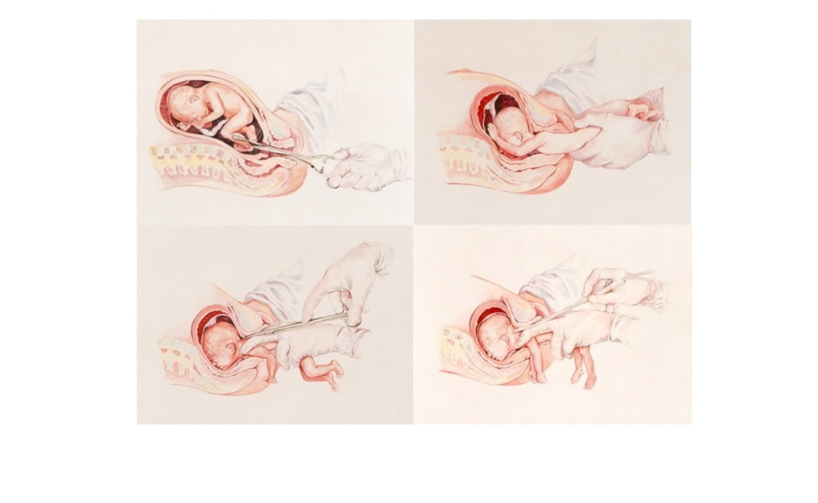 Aborto por nacimiento parcial Aborto por nacimiento parcial