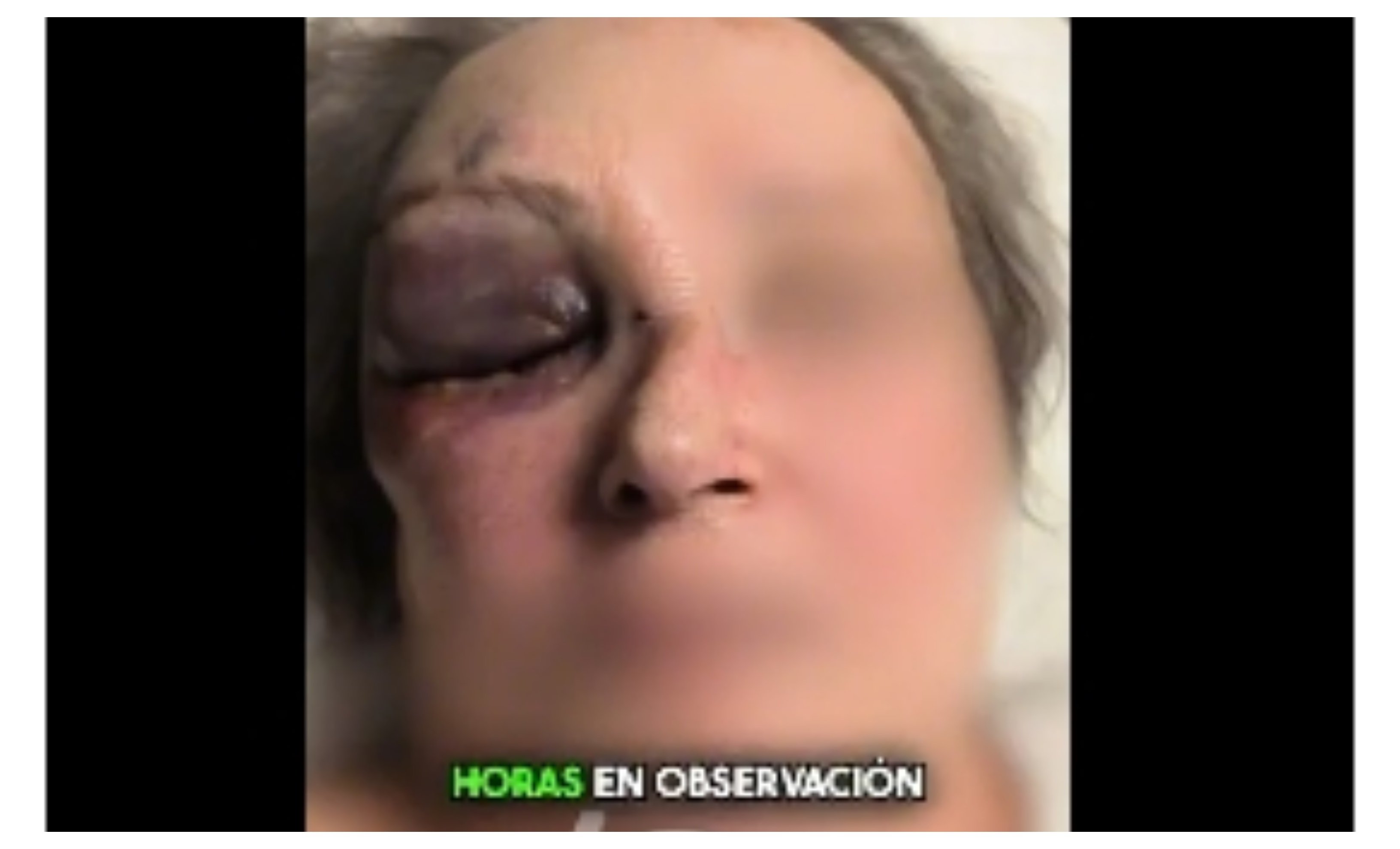 Un pómulo fracturado y un golpe en la cabeza, balance de un robo a una anciana de 85 años, por parte de un marroquí Un pómulo fracturado y un golpe en la cabeza, balance de un robo a una anciana de 85 años, por parte de un marroquí