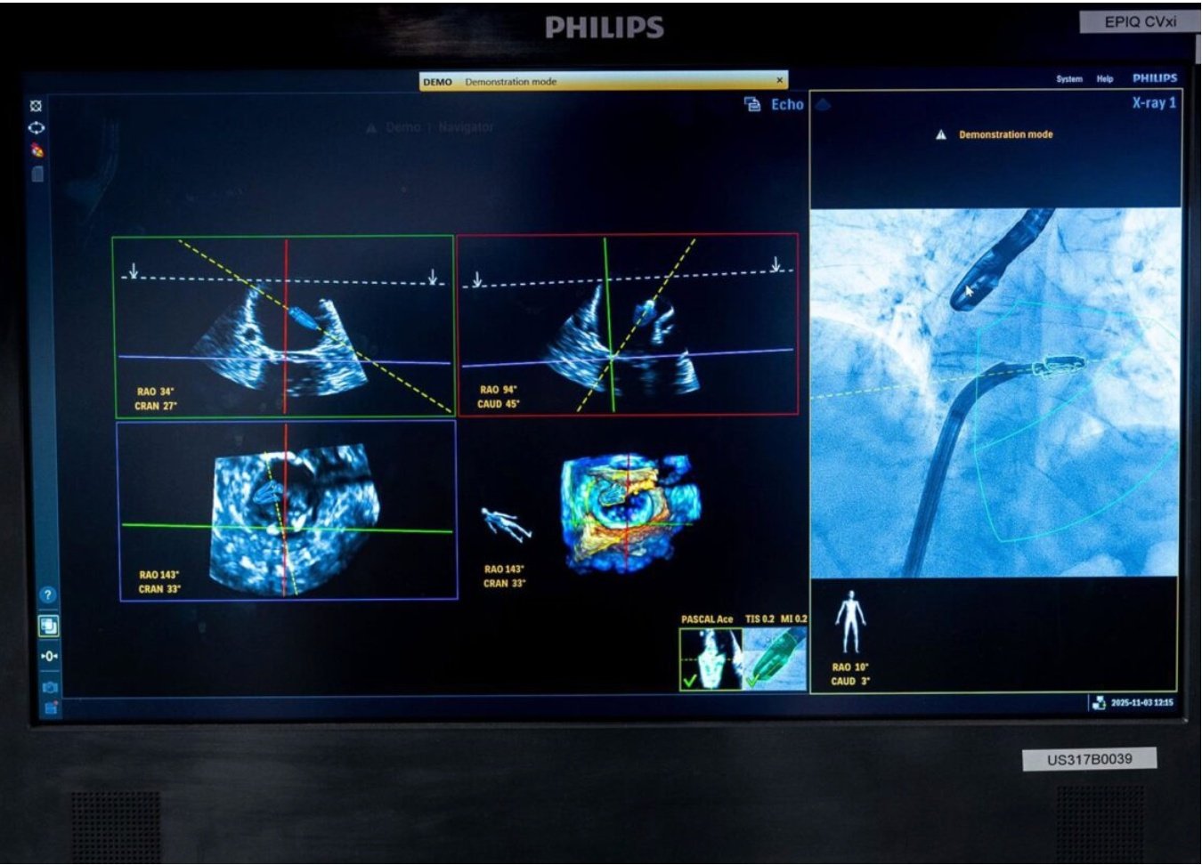 Philips ha presentado una tecnología capaz de ayudar a los médicos, mediante IA, a reparar válvulas mitrales defectuosas sin necesidad de cirugía a corazón abierto Philips ha presentado una tecnología capaz de ayudar a los médicos, mediante IA, a reparar válvulas mitrales defectuosas sin necesidad de cirugía a corazón abierto