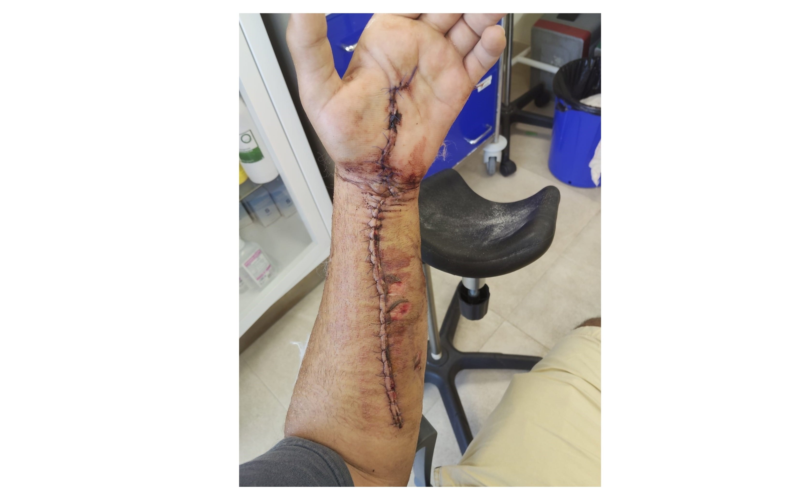 "No perdí el brazo por apenas cinco centímetros. Actualmente, tengo 50 puntos de sutura”, cuenta Jonatan a Hispanidad "No perdí el brazo por apenas cinco centímetros. Actualmente, tengo 50 puntos de sutura”, cuenta Jonatan a Hispanidad