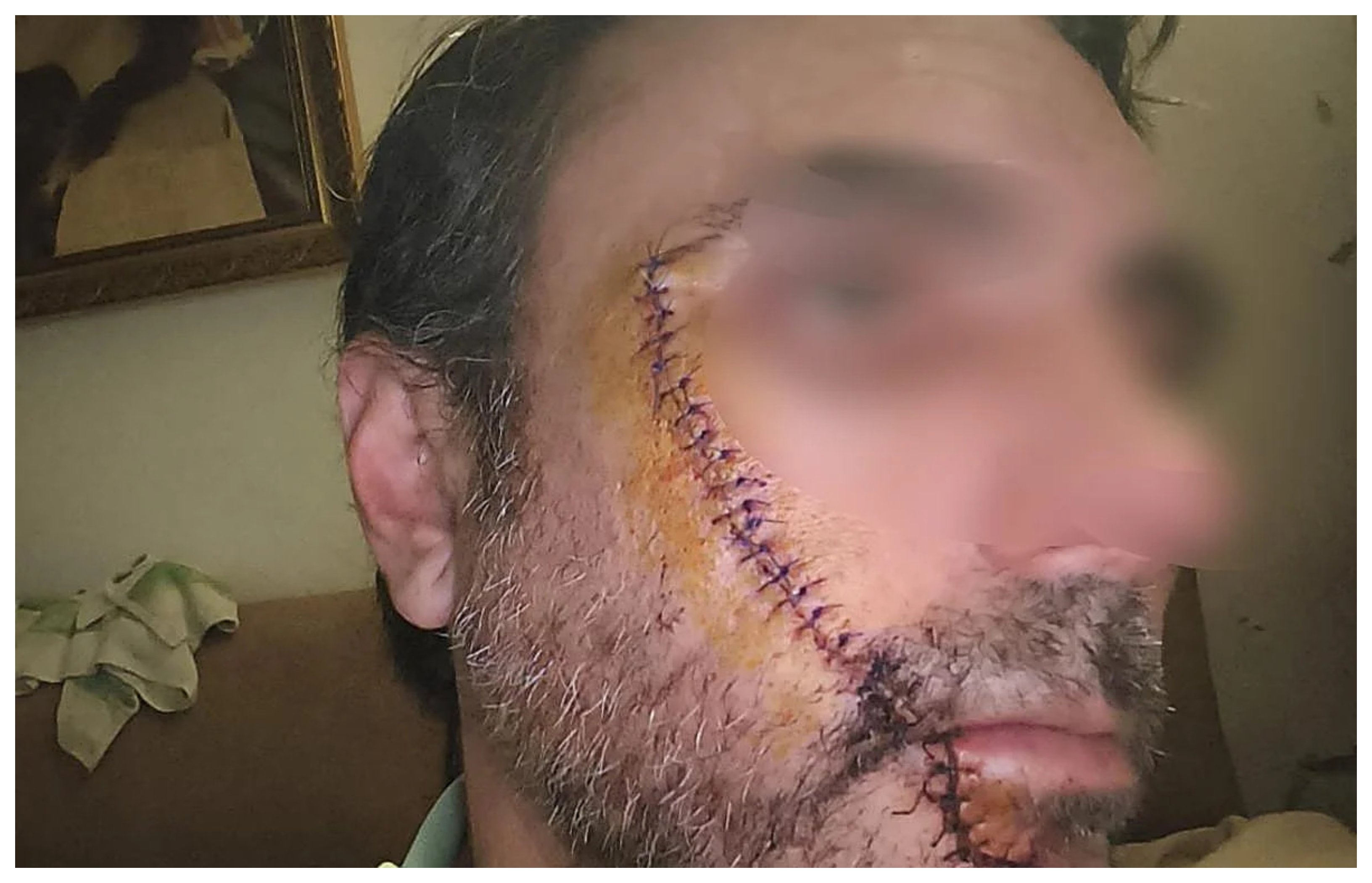 Ha recibido 32 puntos de sutura, desde la ceja al mentón