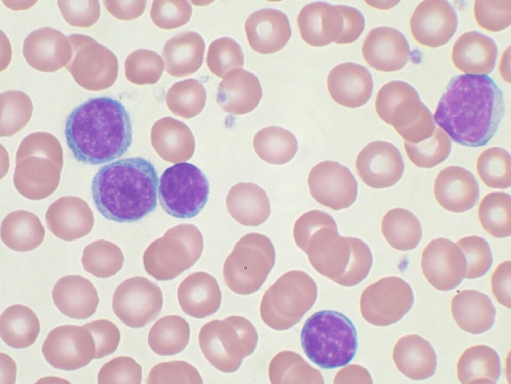 Aunque muchos casos de leucemia linfática crónica siguen detectándose de forma casual y sin síntomas aparentes, los especialistas insisten en la importancia del seguimiento hematológico y del acceso a tratamientos innovadores que están cambiando la historia natural de esta patología