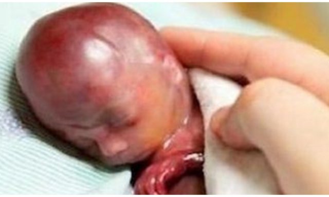 Francia da un paso más en el genocidio de los más indefensos: se podrá abortar hasta justo antes de que el niño nazca Aborto-bebe-envuelto_1_640x384