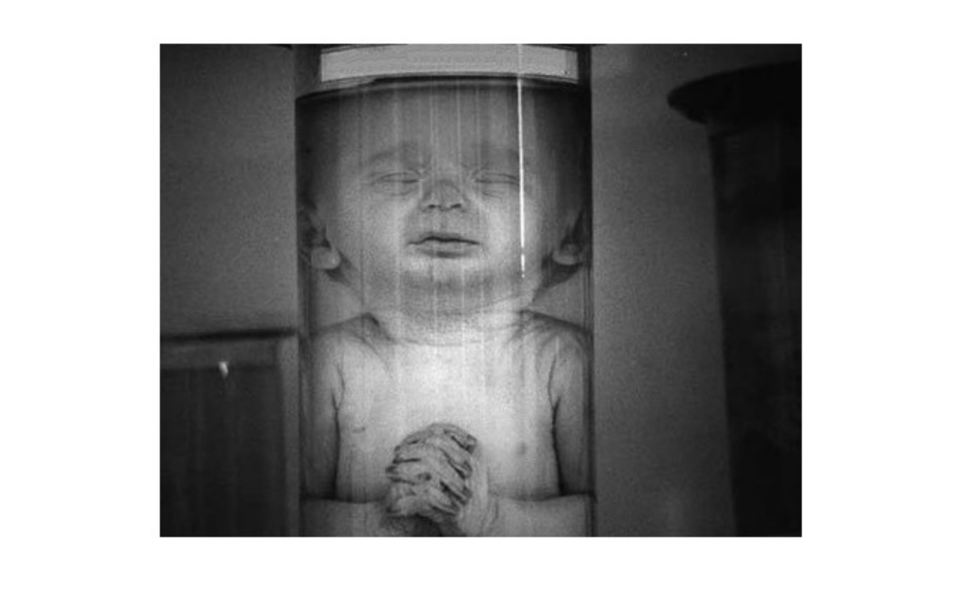 Irlanda del Norte. Como no se aprueba la legalización del aborto, empecemos por los más débiles entre los débiles y practiquemos la eugenesia Irlanda del Norte. Como no se aprueba la legalización del aborto, empecemos por los más débiles entre los débiles y practiquemos la eugenesia