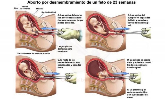 Aborto por desmembramiento de un feto de 23 semanas