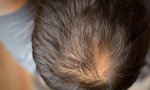 En la zona de la coronilla o ‘vertex’, la alopecia, una vez que se produce, es mucho más difícil de tratar