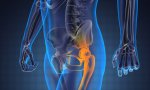 Se pueden reparar a través de la artroscopia de cadera los defectos en el cartílago de la cadera