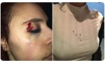La joven colgó un mensaje en las redes sociales en el que denunciaba haber sufrido una «agresión homófoba» en el barrio madrileño de Chueca