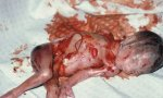 ¿Es el aborto un asesinato? Sí, lo es, el asesinato más cobarde sobre el ser más inocente e indefenso