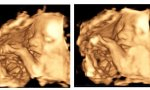 El vídeo que tienen a continuación es el de una ecografía de un bebé de 27 semanas de gestación, con muchas posibilidades de sobrevivir si su madre se pusiera de parto, que puede ser abortado si su madre dijera que el embarazo supone un riesgo para su vida